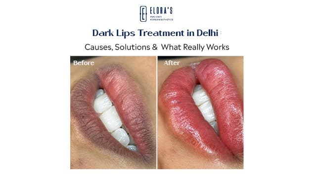 Dark Lips Treatment