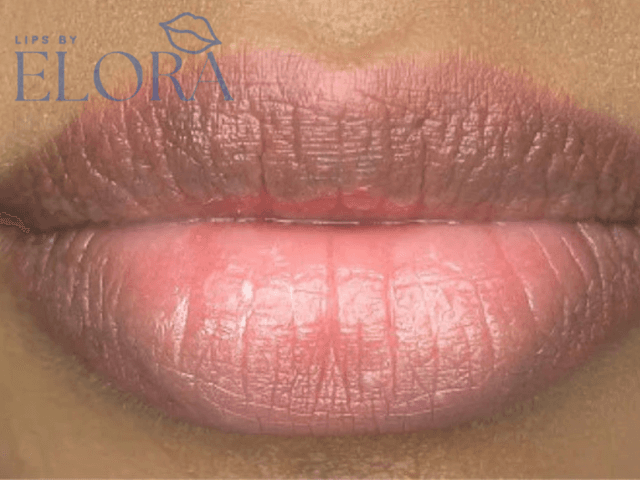 Dark Lip Correction treatment
