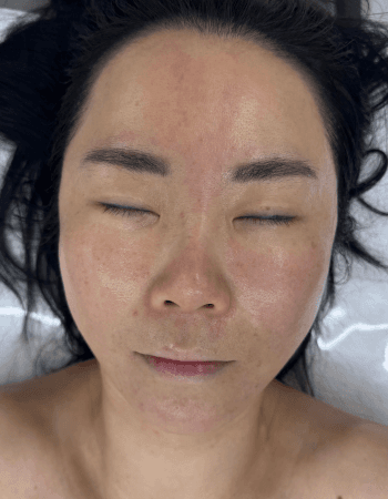 Microneedling Treatment