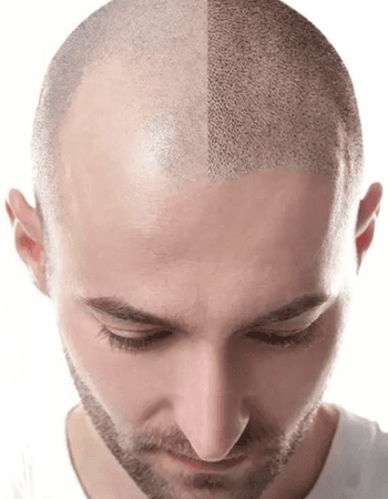 Before and after Scalp Micropigmentation showing a fuller hairline